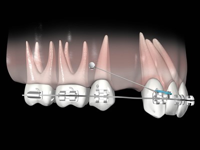 Mini-implantes